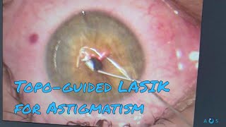 AIIMS New Delhi Dr RP Center for Eye TreatmentOPD appointment LASIK Contoura eye surgery cost [upl. by Petras85]