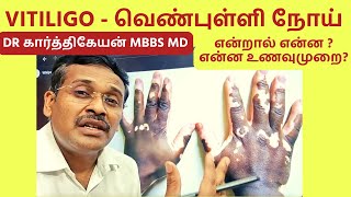 vitiligo skin problem treatment foods home remedies  வெண்புள்ளி நோய் உணவுமுறை [upl. by Erusaert]