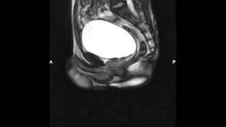 12 Shy Bladder  Paruresis Breath holding in an MRI [upl. by Acacia209]