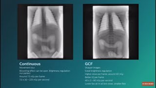 Philips Gridcontrolled fluoroscopy GCF animation video [upl. by Samale]