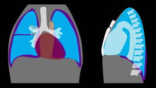 Pneumothorax Explained by Prometheus Lionhart MD [upl. by Rosalynd]