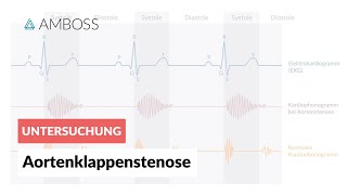 Aortenklappenstenose  Herzgeräusch  AMBOSS Video [upl. by Gorrian112]