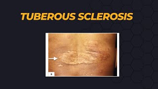 Tuberous Sclerosis [upl. by Nebra]