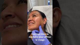 Injection de Botox dans la mâchoire pour affiner le visage DrHerveRaspaldo [upl. by Irish]