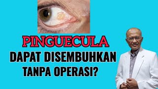 Apakah Pinguecula Bisa Disembuhkan Tanpa Operasi  dr Basuki Rokhmad SpM [upl. by Nalyak]