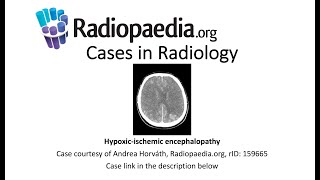 Hypoxicischemic encephalopathy Radiopaediaorg Cases in Radiology [upl. by Mota]