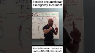 Tension pneumothorax emergency treatment shortvideo shorts drnajeeb drnajeeblectures [upl. by Essirahs]