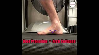 Uncover the link between collapsed arches amp over pronation in our latest video [upl. by Yecnay329]