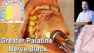 Local Anesthesia Greater Palatine Nerve Block Technique greater Palatine nerve block [upl. by Kred]