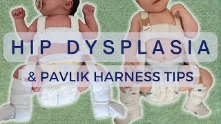 PAVLIK HARNESS AND HIP DYSPLASIA IN NEWBORNS  CARING FOR A BABY IN A PAVLIK HARNESS [upl. by Stutsman]