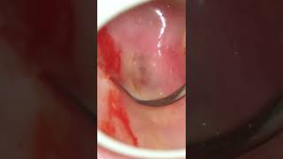 ABSCESS DRAINAGE UBI PUS IBI EVACUA dentist dentistry pimple pus [upl. by Oribelle]