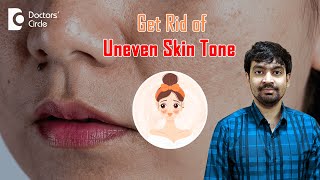 What is Uneven Skin Tone 3 Ways to Get Rid of It unevenskintone DrRajdeep MysoreDoctors Circle [upl. by Halil360]