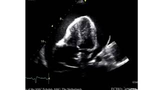 Cardiac Tamponade  Large Pericardial Effusion [upl. by Llenahs3]