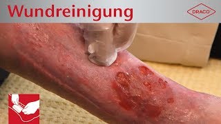 Wundreinigung Debridement bei chronischer Wunde  Verbandswechsel  DRACO [upl. by Idolla]