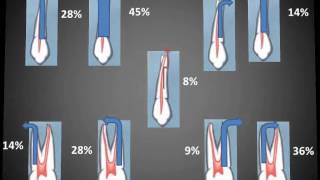 Primer premolar superiorwmv [upl. by Froehlich26]