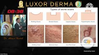 Acne amp Rosacea by Dr Ahmed kadah [upl. by Ttennaej773]