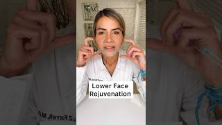 Lower Face Rejuvenation drbitafarrell botox fillers [upl. by Aticnemrac]