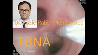 Transbronchial Needle Aspiration TBNA by Dr Fazle Rabbi Md at SQUARE HOSPITALS LTD BDENDOSCOPY [upl. by Ama]