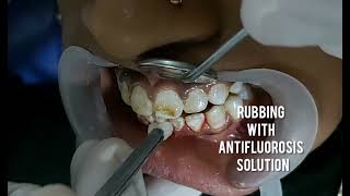 Fluorosis treatment [upl. by Arremat]