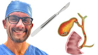 Treating Acute Cholecystitis with a Surgeon [upl. by Inaleon]