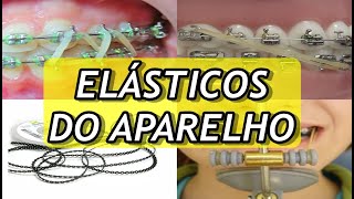 Tipos de ELÁSTICOS do Aparelho Ortodôntico  FUNÇÕES DE CADA UM DELES [upl. by Htiekel730]