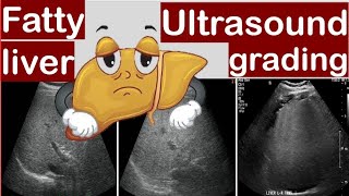 Fatty liver Ultrasound grading [upl. by Jorie]