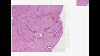 Histopathology BreastFibroadenoma [upl. by Charmine]