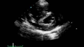 A 17YearOld Girl with Chest Pain and Hemoptysis [upl. by Nnylsor260]