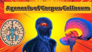 Agenesis of Corpus Callosum Brain Disorder 🧠 🧠🧠🧠🧠 [upl. by Lemert]