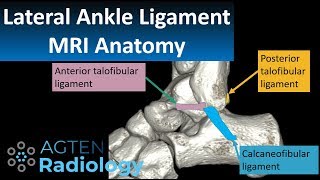 MRI Anatomy of lateral ankle ligaments [upl. by Aramahs]