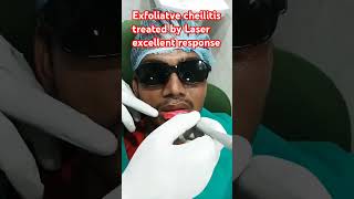 Exfoliatve cheilitis treated by Laser excellent response [upl. by Norraj]