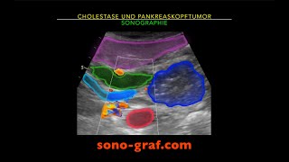 Sonographie  Cholestase und Pankreaskopftumor [upl. by Anetta]