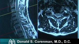 How to Read a MRI of Cervical Nerve Compression  Neck Pain  Colorado Spine Surgeon [upl. by Ainex494]