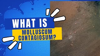 What is molluscum contagiosum [upl. by Ondrea]