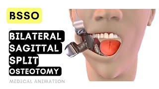 Bilateral Sagittal Split Osteotomy  surgical video [upl. by Canada]