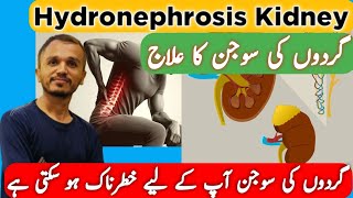 Hydronephrosis Kidney  Hydronephrosis Homeopathic Medicine  Kidney Swelling Treatment [upl. by Bibbie363]