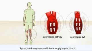 Zakrzepica  Przyczyny i leczenie [upl. by Riddle]