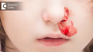 Causes amp management of early morning nose bleed in children  Dr Sreenivasa Murthy T M [upl. by Ecirtap]