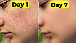 7 Days Clear Skin Challenge With Home Remedies  Clear Tiny Bumps from Forehead amp Face [upl. by Cameron]