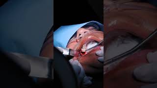 Dental Bone Graft for Implant Restoration  Torrance Oral Surgery amp Dental Implant Center [upl. by Kared]