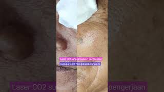 Hasil Zoom 1000x Giant Keratosis Sebhoreik MAU LIHAT shineryaesthetic laserco2 [upl. by Eimrej]