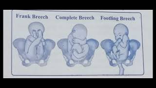 Breech presentation  obg  bsc nursing gnm  obg [upl. by Annayoj]