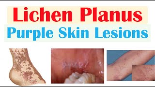 Lichen Planus “Purple Skin Lesions”  Causes Signs amp Symptoms Diagnosis Treatment [upl. by Hooker]