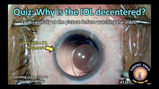 CataractCoach 1547 Quiz Why is the IOL decentered [upl. by Kaazi]