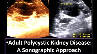 Understanding Adult Polycystic Kidney Disease A Sonographic Approach  Polycystic Kidney Disease [upl. by Welford]