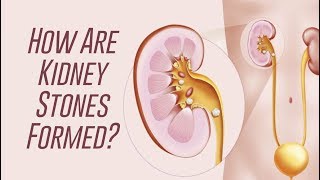 How Kidney Stones are Formed [upl. by Ydisac787]