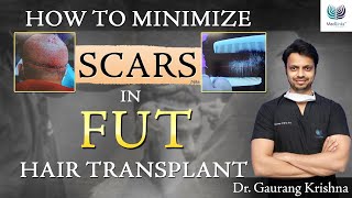 Why Patients are moving away from FUT FUT Hair Transplant Before amp After MedLinks Hair Transplants [upl. by Entwistle907]