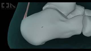 MinimallyInvasive Haglunds Deformity Surgery [upl. by Colwen65]