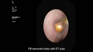 Bronchoscopy Saves 14MonthOld Rare Pulmonary Edema Managed PostForeign Body Removal Dr Subhakar [upl. by Elicul]