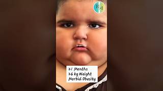 Morbid Obesity  Prader willi syndrome  Cushingoid baby gynecologist gynaecologists [upl. by Amitak472]